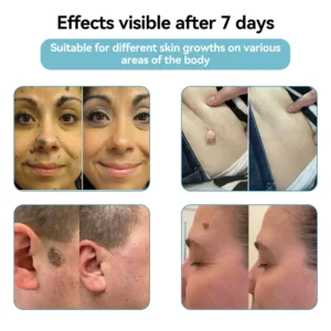 VelvetSkin+ All-in-One Laser Eraser Pen - Image 3