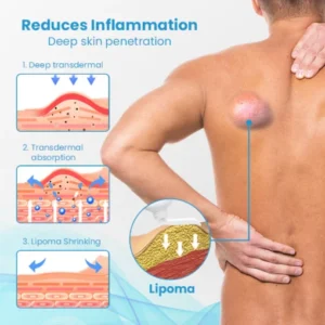 HEALumps Lipoma Treatment Ointment - Image 7