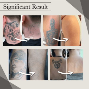 Natural Fading Tattoo Removal Cream - Image 4