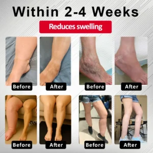 Advanced CVI Edema Therapy Cream - Image 3