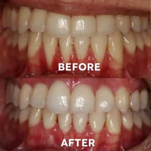 Fluoride-Free Nano Hydroxyapatite Tooth Powder - Image 4