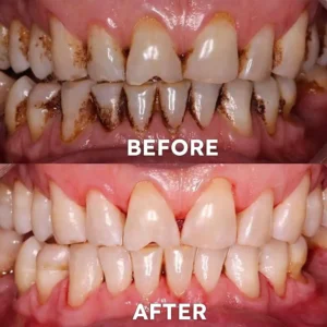 Fluoride-Free Nano Hydroxyapatite Tooth Powder - Image 6