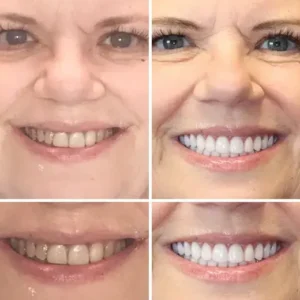 OFFICIAL STORE: – 🦷Advanced Customized Full Denture Set - Image 3