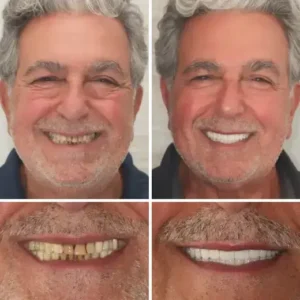 【Official Brand Store】Custom-Fit Functional Dentures — ComfortMax Edition - Image 10