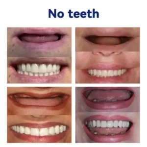 Official Store | Advanced Full Denture Set 🦷 - Image 9