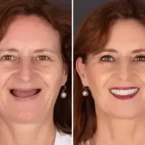 SmileFitPro BioFusion Dentures - Image 9