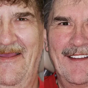 🌟 – Custom-Crafted Dentures That Feel as Natural as They Look👩‍🔬 - Image 12