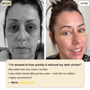 ✅Official Store: Deep Precision Age-Defying Nano Microneedle Patches – Deep-acting solution for tackling under-eye bags, dark circles, laughter lines, forehead lines, and all those other pesky facial wrinkles. - Image 4