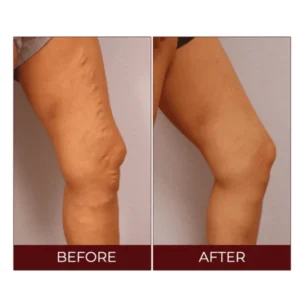 Varicose Veins Relief Cream - Image 5