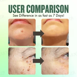 WartsOff Instant Blemish Removal Cream - Image 4
