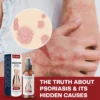 DermSoothe Psoriasis Relief Spray