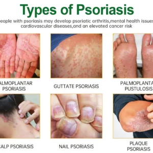 Knotaway Psoriasis Cream - Image 3