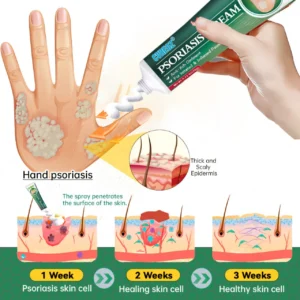 Knotaway Psoriasis Cream - Image 4