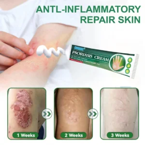Knotaway Psoriasis Cream - Image 5