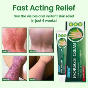 Knotaway Psoriasis Cream - Image 8
