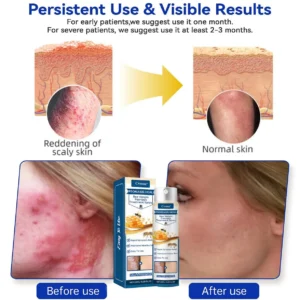 Psoriasis Heal Bee Venom Spray - Image 6