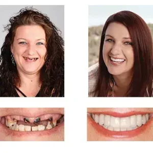🦷 Custom-Fit Functional Dentures 😁 Smile with Confidence - Image 5
