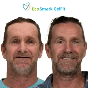 EcoSmark GelFit Dentures - Image 7