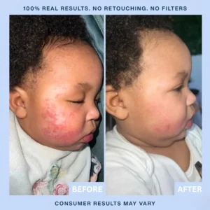 Eczema & Psoriasis Cream - Image 3