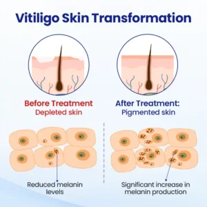 Evenora Vitiligo Herbal Spray - Image 7