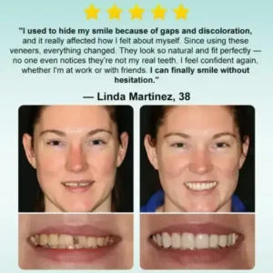 Instant Stick-on Dental Veneers (✅Clinically proven, easy-to-use dental veneers trusted by over 8,000 US users for a comfortable, natural smile.) - Image 5