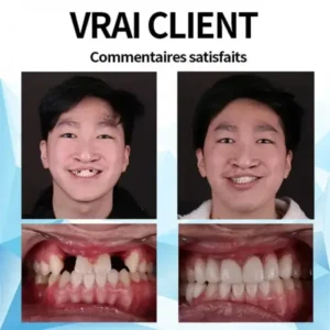 Silicone Reline Denture Set - Image 2