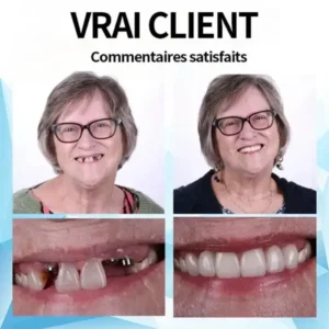 Silicone Reline Denture Set - Image 9