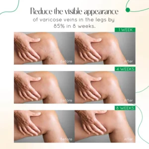 Vein Therapy Cream - Image 3