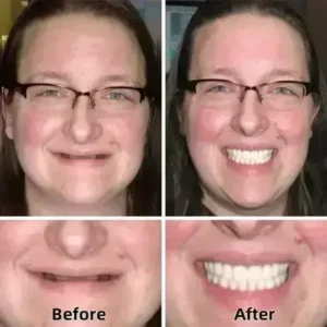 –Advanced Custom-Fit Functional Dentures - Image 4