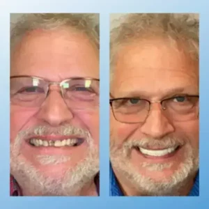 😁 “Snap In. Stay Put. Smile All Day — Or Your Money Back!” 𝗙𝘂𝗻𝗰𝘁𝗶𝗼𝗻𝗮𝗹 𝗧𝗵𝗶𝗰𝗸𝗲𝗻𝗲𝗱 𝗗𝗲𝗻𝘁𝘂𝗿𝗲𝘀 - Image 5