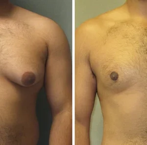 Gynecomastia Cream – Chest Fat Burner - Image 5