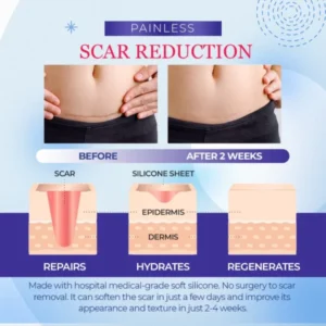 Grade Silicone Scar Sheets - Image 5