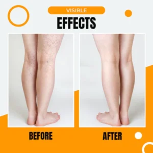 Anti-Varicose Veins Compression Stockings - Image 4