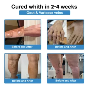 ✅ official Nano👩‍⚕️(COA) Recommended microneedle joint patch (painless, long-lasting, suitable for arthritis varicose veins and various orthopedic disease） - Image 9