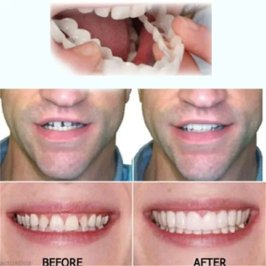 Adjustable Snap-On Dentures - Image 7