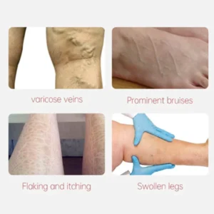 Varicose Veins Relief Cream - Image 3