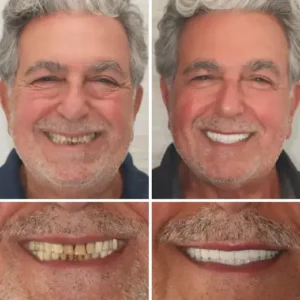 Custom-Fit Functional Dentures - Image 4