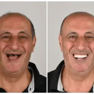Alternative view of 🦷 Custom-Fit Functional Dentures 😁 Smile with Confidence