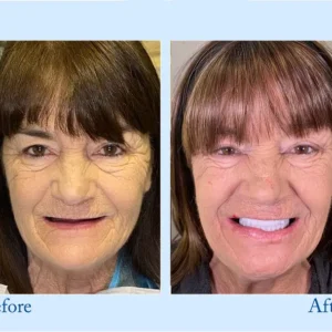 Digital Custom-Fit Functional Dentures - Image 6