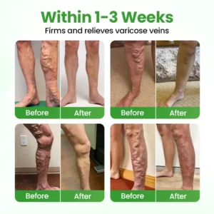 Alternative view of VeinHeal Microneedle Patch