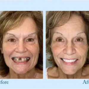 – Premium-Zahnprothese - Image 7