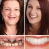 Full Denture with Strong Suctiond🦷