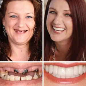 Full Denture with Strong Suctiond🦷 - Image 2