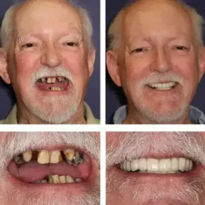 【Official Brand -Custom-Fit Functional Dentures — Combination pack - Image 5