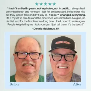 🦷Advanced Customized Full Denture Set🦷 (🔥10,000+ Sold In Last 30 Day) - Image 13