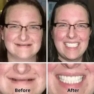 –Advanced Custom-Fit Functional Dentures - Image 4