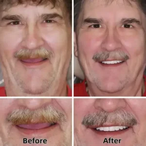 –Advanced Custom-Fit Functional Dentures - Image 6