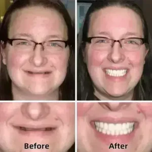–Advanced Custom-Fit Functional Dentures - Image 4