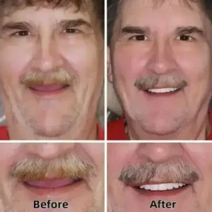 –Advanced Custom-Fit Functional Dentures - Image 6