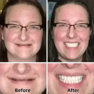 –Advanced Custom-Fit Functional Dentures - Image 2